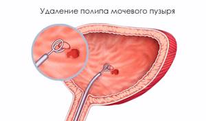 Можно Ли Заниматься Сексом После Цистоскопии