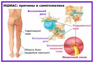 Седалищный нерв где находится рисунок