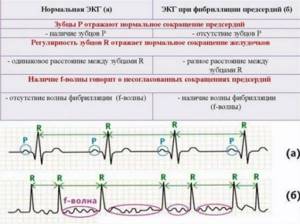 Фибрилляция желудочков карта вызова