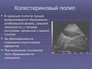 Лечение полипов желчного пузыря под руководством агапова михаила андреевича