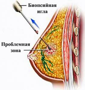 Пункция Молочной Железы Фото