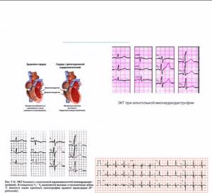 Экг при дилатационной кардиомиопатии фото