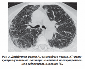 Ретикулярные изменения в легких. Первичный бронхолегочный амилоидоз. Первичный амилоидоз легких.
