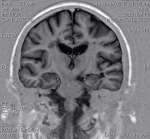 Очаговые изменения мозга дистрофического дисциркуляторного характера. Положительный симптом пальцев Доусона.