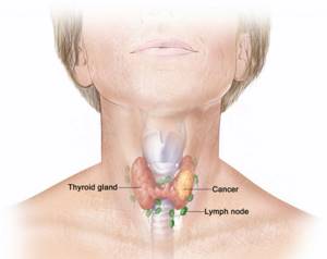 Sintoma de cancer de tiroides