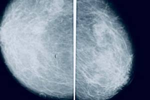 Маммография фкм. Фиброзная мастопатия молочной железы маммография. Фиброзная мастопатия на маммографии. Диффузный фиброаденоматоз. Кистозная мастопатия маммография.