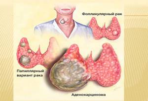 От чего зависит продолжительность жизни при раке щитовидки