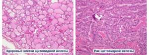 Патогенез рака щитовидной железы