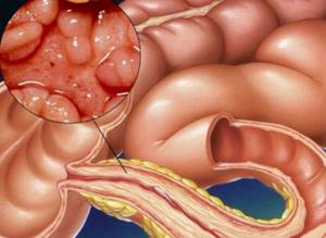 Стеноз кишечника: причины, симптомы, лечение и диета