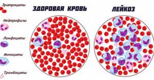 Симптомы заболевания раком крови