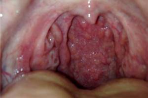 Рак горла – симптомы и прогноз на всех стадиях болезни