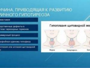 Симптомы и причины возникновения гипоплазии щитовидки у взрослых