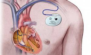 Сколько стоит операция по установке кардиостимулятора сердца?