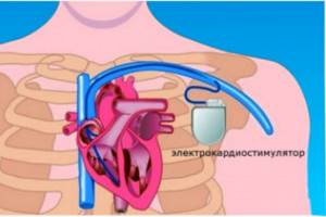 Что такое кардиостимулятор и как он работает?