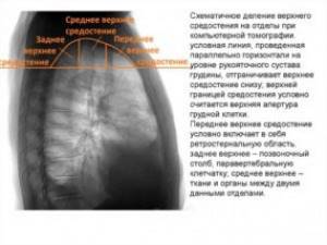 Рентгеновская диагностика заболеваний верхнего средостения | Второе мнение