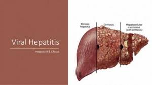 Что такое гепатиты В и С?