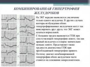 Гипертрофия левого желудочка на кардиограмме: ошибка или симптом тяжелого заболевания?