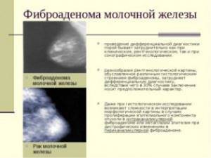 Фиброаденома молочной железы: опасна ли она и может ли перерасти в рак