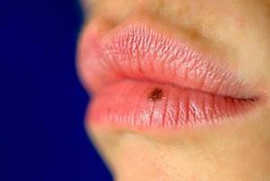 Папиллома на слизистой рта симптомы и причины появления вируса