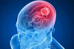 Клинические проявления рака головного мозга