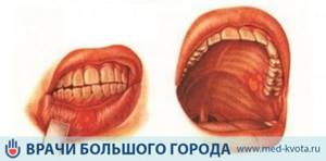 Первые симптомы и признаки начальной стадии Первые симптомы и признаки начальной стадии