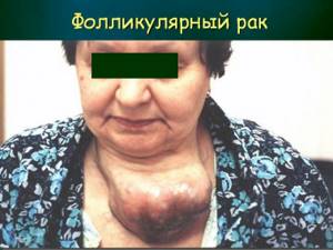 Первые симптомы и признаки начальной стадии Первые симптомы и признаки начальной стадии