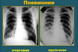 Как определить очаговую пневмонию на рентгенограмме