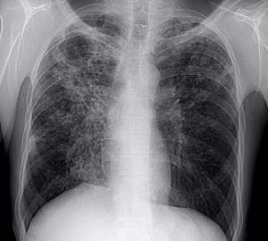 Как определить очаговую пневмонию на рентгенограмме
