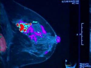 Что такое карцинома грудной железы