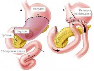 Методы лечения полипов желудка