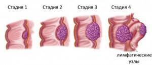 Стадии плоскоклеточного рака прямой кишки