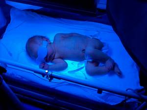 Как протекает и каковы же причины желтухи у недоношенных новорожденных детей?