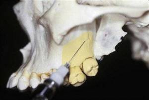 Применение туберальной анестезии в стоматологии