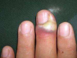 Как быстро вылечить нарыв на пальце возле ногтя или панариций