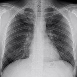 Причины усиления прикорневого рисунка лёгких на рентгене |