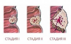 Выделяют четыре стадии аденокарциномы кишечника: