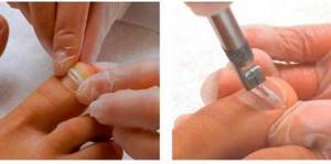 Основные правила лечения вросшего ногтя дома