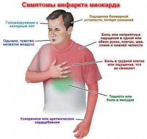 Инфаркт миокарда – симптомы
