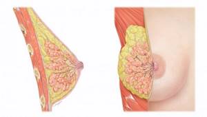 Все о патологиях железистой ткани молочной железы: гиперплазия и железистая мастопатия