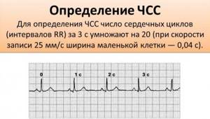 Анализ кардиограммы