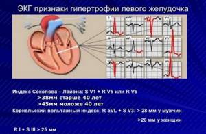 Индексы Соколова (критерии Соколова-Лайона гипертрофии желудочков)