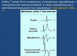 Индексы Соколова (критерии Соколова-Лайона гипертрофии желудочков)