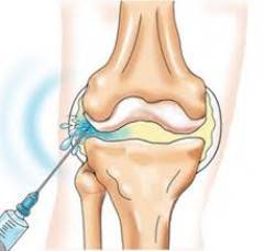 Лечение бурсита коленного сустава