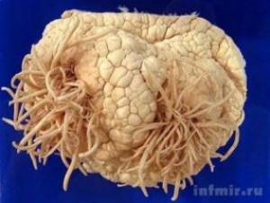Симптомы и лечение паразитов в головном мозге человека