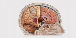 Сколько живут с глиобластомой головного мозга после операции на 1-степени