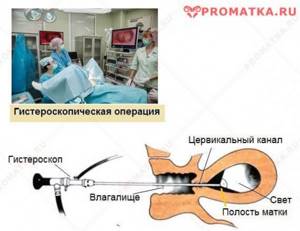 Полип эндометрия и беременность Полип эндометрия и беременность