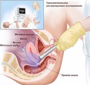 Полип эндометрия и беременность