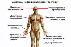 Что представляет собой ВСД по гипотоническому типу? Что представляет собой ВСД по гипотоническому типу?