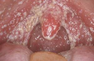 Кондиломы во рту: лечение