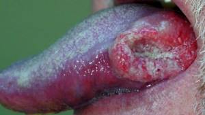 Виды и симптомы рака языка